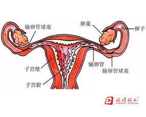 双侧输卵管堵塞能去泰国做试管吗