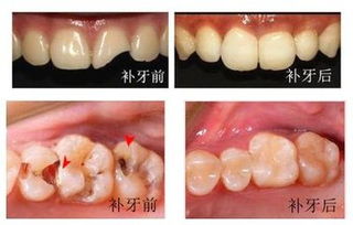 苏州虎丘区补颗牙一般多少钱