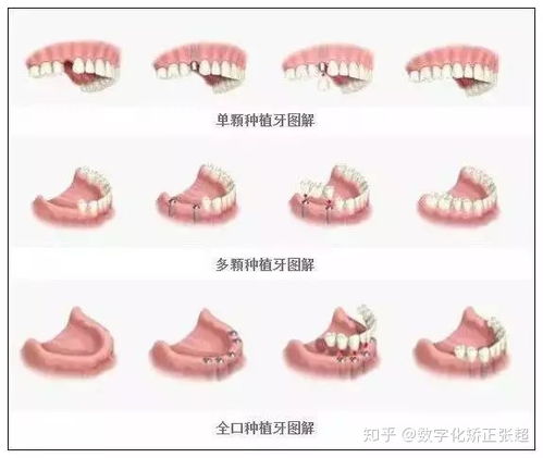 种植牙可以搭桥吗(种植牙可以搭桥吗图片)