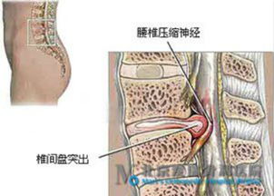 腰间盘突出百万医疗保险能报销吗腰椎间盘突出保险公司理赔吗