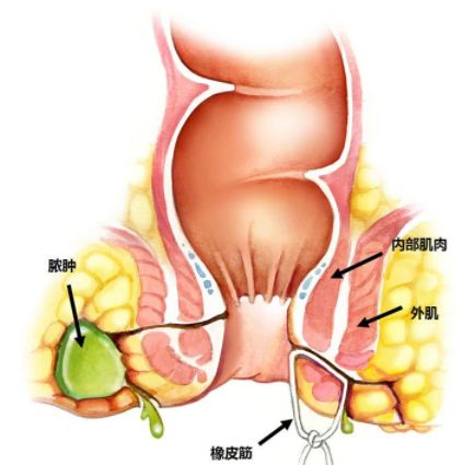 肛瘘非手术治疗才可以吗 手术是治疗的关键途径