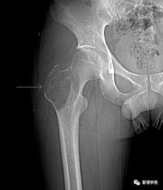 右髋部酸痛半年,摔伤后疼痛 软骨母细胞瘤合并动脉瘤样骨囊肿