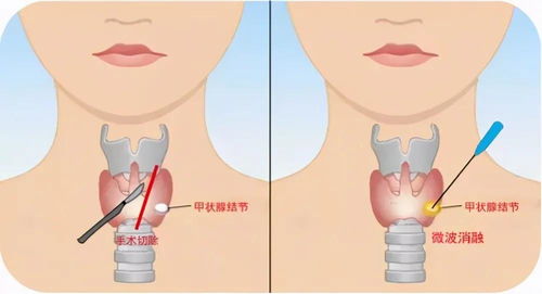 甲状腺结节这些谣言你确定不来了解一下吗