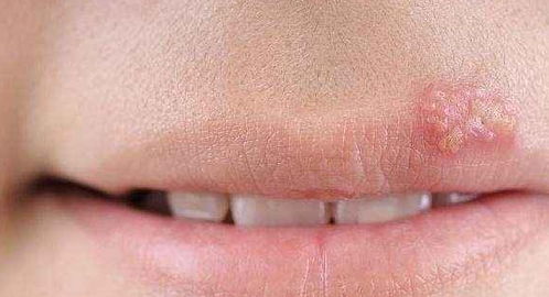 嘴上长泡是在排毒 可能 暗藏 4大疾病风险,你注意到了吗