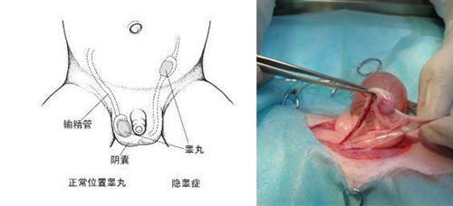 隐睾手术怎么做