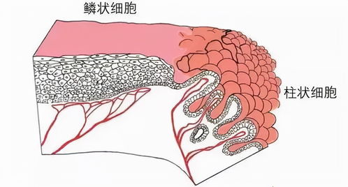 检查出宫颈囊肿怎么办 是不是离宫颈癌不远了