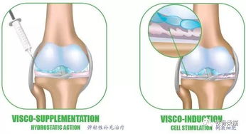 膝关节炎注射玻璃酸钠效果如何 到底该不该用