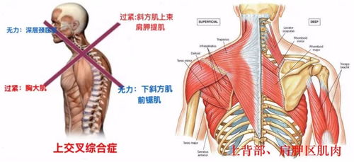 含胸圆肩驼背,这5个康复训练你得收藏着 