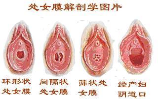 处女膜出血较多如何处理