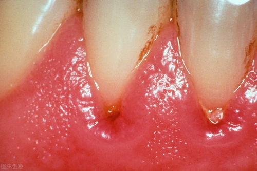 牙菌斑？牙菌斑形成的原因