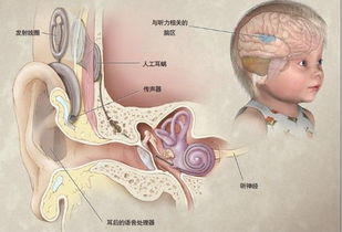 如何选择合适的人工耳蜗