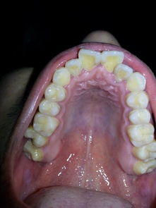 牙齿矫正 主要是门牙突出 是拔牙好还是磨牙好呢 