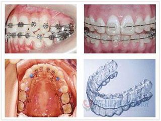 牙齿矫正后会反弹吗 什么方法矫正牙齿