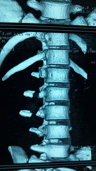 腰椎横突骨折图解 搜狗图片搜索
