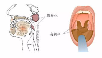 宝宝睡觉老打呼噜 微创治疗解决难题