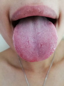 舌头边缘有齿痕 前几天口气重舌苔黄 昨天感冒了 早晨发现舌苔变白且有少量花纹 买了黄芪打算泡水 