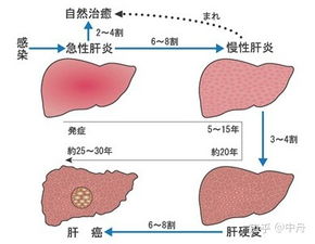 慢性乙肝 慢性乙肝可以治愈吗