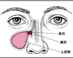 引发急性鼻炎的原因有哪些 