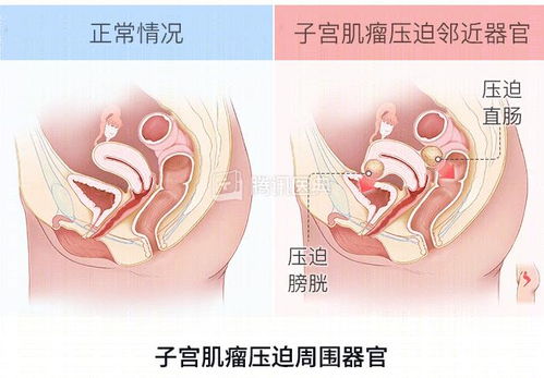 女、33岁，肠炎，经调理后还会便秘(肠炎好后大便干结原因)