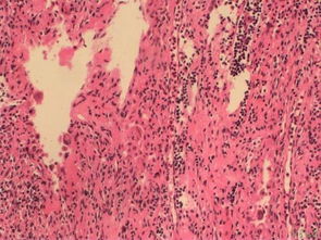朗格汉斯组织细胞增生症(朗格汉斯细胞组织细胞增生症)