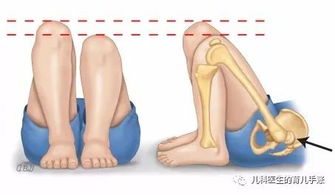 什么是先天性髋关节发育不良 儿疾科普