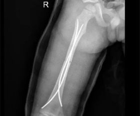 帕瓦尔左膝骨脱臼后遗症，佩戴支架康复需3-4周