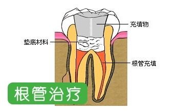 牙根疼痛怎么治疗(牙根痛什么原因引起的)