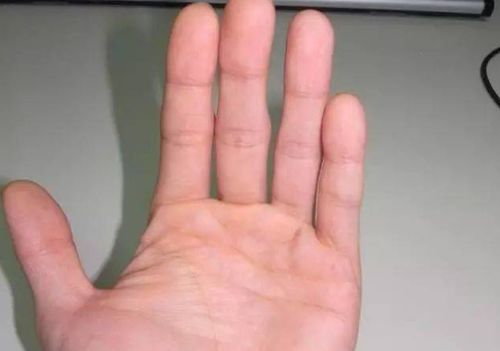 若手掌出现5大异常,可能是肝脏 病变 ,占一个也劝你早查肝CT