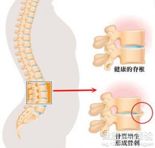 骨质增生患者一定要注意补钙