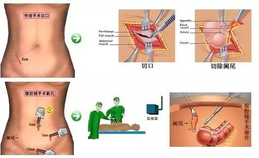 腹腔鏡闌尾炎手術為什么要打3個洞,每個洞是干什么用(腹腔鏡闌尾炎手術器械)