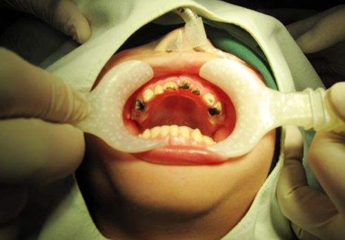 3岁女童竟长了十几颗坏牙,都是长期吃 它 造成的 