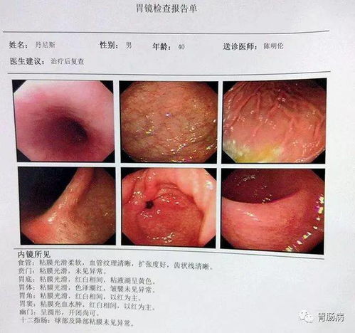 胃镜检查那些事儿