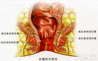 肛瘘不手术用药可以治愈吗