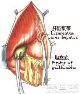 慢性胆囊炎怎么处理