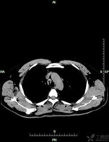 胸部CT