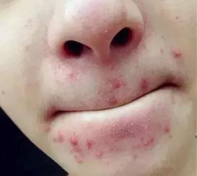 嘴角旁边长痘痘是什么原因