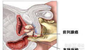 有前列腺肉瘤怎么办