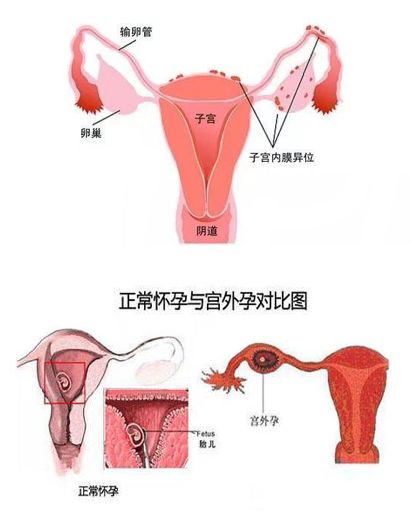 宫外怀孕是怎样引起的？女人宫外孕是什么原因产生的