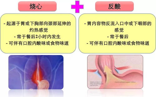 总是烧心,究竟是啥原因