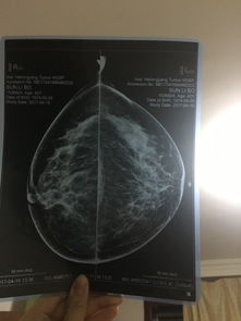 钼靶检查是右侧4A左侧1,会是乳腺癌么 