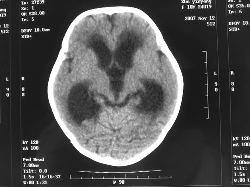 女,10月 呕吐3天,四肢乏力6天 脉络丛乳头状瘤并交通性脑积水