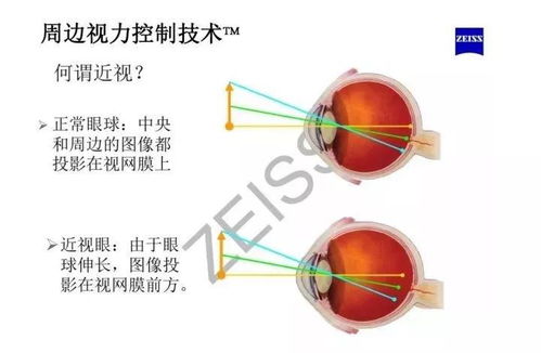嗨视力知识科普丨从离焦镜片对比单焦点镜片来谈预防近视