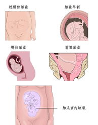 剖腹产分娩必知 整个剖腹产手术全过程图片 3 