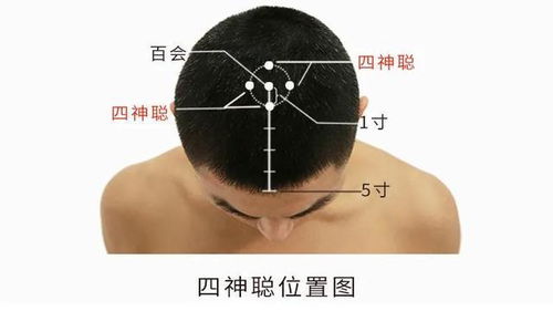 前头痛 后头痛 偏头痛 巅顶痛等,用这些穴位来应对各种头痛