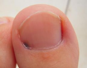 脚趾甲有灰指甲是什么症状