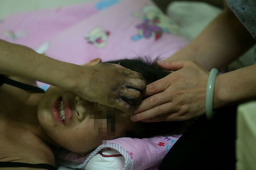 女童在 国学班 遭针扎指甲踩断锁骨 
