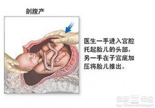 剖腹产后多久能提重东西