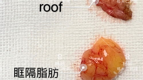 Roof祛除 治疗肉眼泡