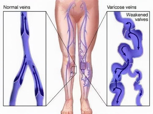 静脉曲张只靠涂药就能够根治 医生这样说
