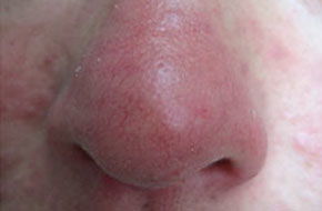 鼻子有小脓包丘疹红红的是因为什么